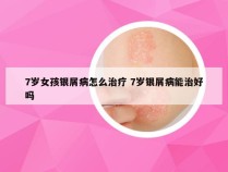7岁女孩银屑病怎么治疗 7岁银屑病能治好吗