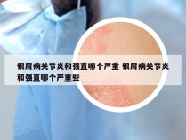 银屑病关节炎和强直哪个严重 银屑病关节炎和强直哪个严重些