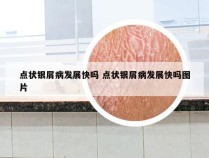 点状银屑病发展快吗 点状银屑病发展快吗图片