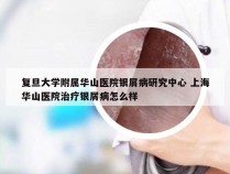 复旦大学附属华山医院银屑病研究中心 上海华山医院治疗银屑病怎么样