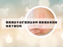 银屑病会不会扩散到全身啊 银屑病会串到身体各个部位吗