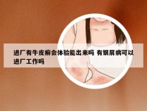 进厂有牛皮癣会体验能出来吗 有银屑病可以进厂工作吗