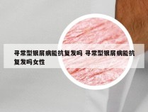 寻常型银屑病能抗复发吗 寻常型银屑病能抗复发吗女性