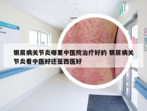 银屑病关节炎哪里中医院治疗好的 银屑病关节炎看中医好还是西医好