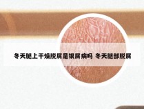 冬天腿上干燥脱屑是银屑病吗 冬天腿部脱屑