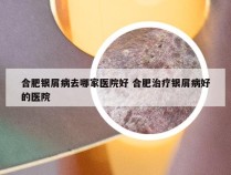 合肥银屑病去哪家医院好 合肥治疗银屑病好的医院