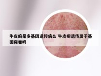 牛皮癣是多基因遗传病么 牛皮癣遗传属于基因突变吗