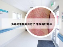 多年的牛皮癣自愈了 牛皮癣好几年