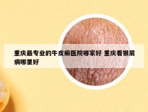 重庆最专业的牛皮癣医院哪家好 重庆看银屑病哪里好