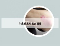 牛皮癣黑印怎么消除