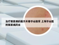 治疗银屑病的偏方长春华山独家 上海华山医院银屑病药水