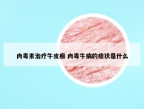 肉毒素治疗牛皮癣 肉毒牛病的症状是什么