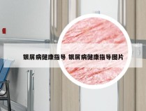 银屑病健康指导 银屑病健康指导图片