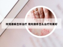 玫瑰康癣怎样治疗 瑰玫康疹怎么冶疗效果好