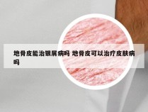 地骨皮能治银屑病吗 地骨皮可以治疗皮肤病吗