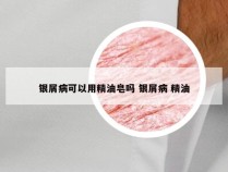 银屑病可以用精油皂吗 银屑病 精油