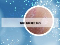 苔癣 苔癣用什么药
