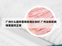 广州什么医院看银屑病比较好 广州治银屑病哪里医院正规