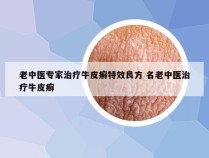 老中医专家治疗牛皮癣特效良方 名老中医治疗牛皮癣