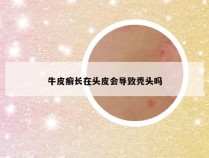 牛皮癣长在头皮会导致秃头吗