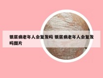 银屑病老年人会复发吗 银屑病老年人会复发吗图片