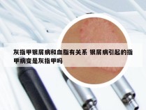 灰指甲银屑病和血脂有关系 银屑病引起的指甲病变是灰指甲吗