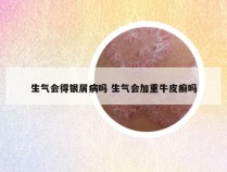 生气会得银屑病吗 生气会加重牛皮癣吗