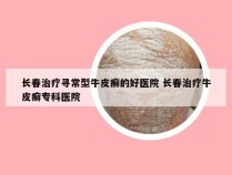 长春治疗寻常型牛皮癣的好医院 长春治疗牛皮癣专科医院