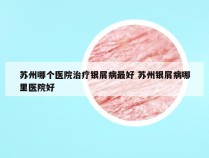 苏州哪个医院治疗银屑病最好 苏州银屑病哪里医院好