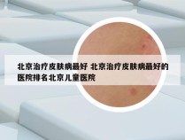 北京治疗皮肤病最好 北京治疗皮肤病最好的医院排名北京儿童医院