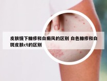 皮肤镜下糠疹和白癜风的区别 白色糠疹和白斑皮肤ct的区别