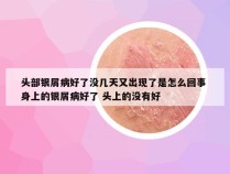 头部银屑病好了没几天又出现了是怎么回事 身上的银屑病好了 头上的没有好