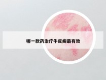哪一款药治疗牛皮癣最有效