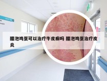 醋泡鸡蛋可以治疗牛皮癣吗 醋泡鸡蛋治疗皮炎