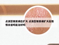 点滴型银屑病在扩大 点滴型银屑病扩大后慢慢会退吗能治好吗