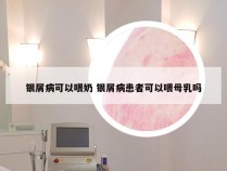 银屑病可以喂奶 银屑病患者可以喂母乳吗