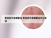 章贡区牛皮癣整治 章贡区牛皮癣整治中心电话
