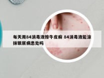 每天用84消毒液擦牛皮癣 84消毒液能涂抹银屑病患处吗