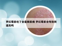 罗红霉素吃了会是银屑病 罗红霉素会导致阴道炎吗