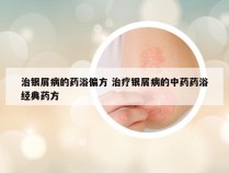 治银屑病的药浴偏方 治疗银屑病的中药药浴经典药方