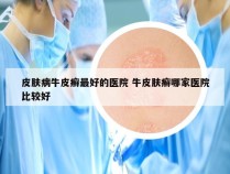 皮肤病牛皮癣最好的医院 牛皮肤癣哪家医院比较好