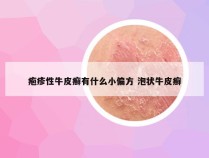 疱疹性牛皮癣有什么小偏方 泡状牛皮癣