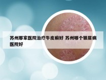 苏州那家医院治疗牛皮癣好 苏州哪个银屑病医院好