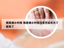 银屑病小时候 银屑病小时候没有然后长大了就有了