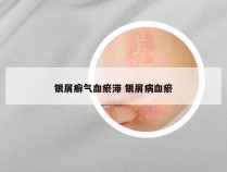 银屑癣气血瘀滞 银屑病血瘀