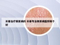 长春治疗银屑病的 长春专治银屑病医院哪个好