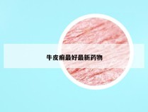 牛皮癣最好最新药物