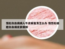 慢粒白血病病人牛皮癣复发怎么办 慢性粒细胞白血病皮肤瘙痒