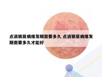 点滴银屑病爆发期需要多久 点滴银屑病爆发期需要多久才能好