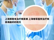 上海哪里有治疗银屑病 上海哪家医院治疗银屑病最好的地方